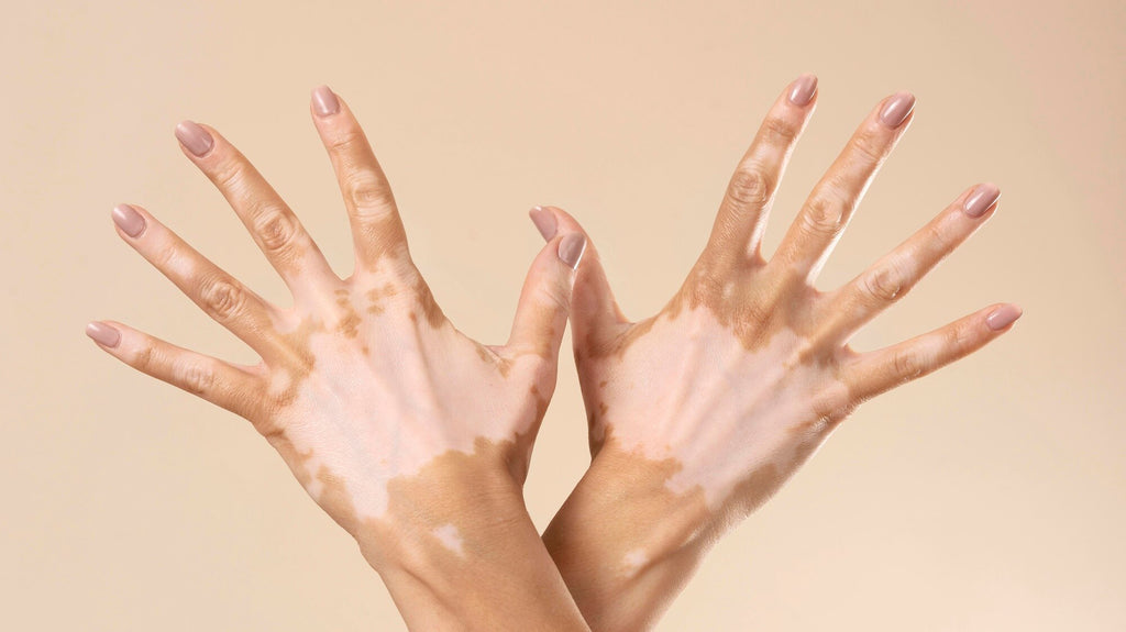 vitiligo mimvio kolostrum